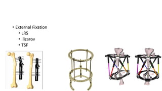 • External Fixation
• LRS
• Ilizarov
• TSF
 