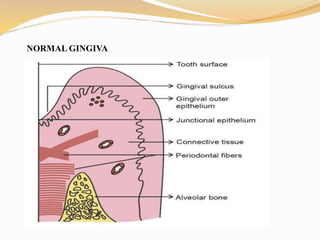 Normal Gingiva Pathogenesis of plaque associated periodontal disease | PPTX