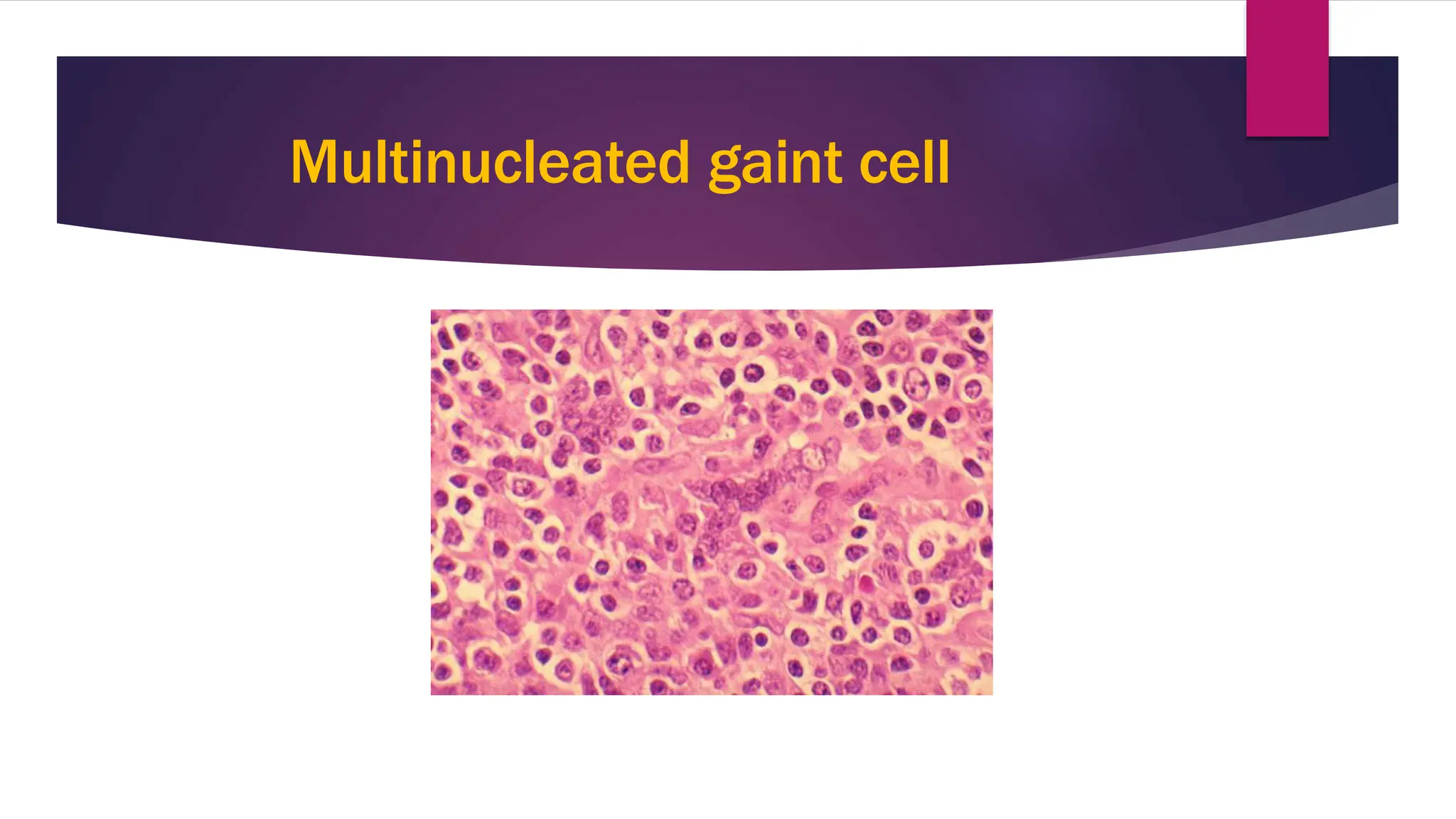 Multinucleated gaint cell
1
0
 