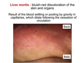 Livor mortis - bluish-red discoloration of the
skin and organs
Result of the blood settling or pooling by gravity in
capillaries, which dilate following the cessation of
circulation
Back
Belly
it is absent where there is
pressure which prevents
dilation of capillaries
Livor due to hyopstasis ﬁrst 8-12Hrs
Livor due to imbibition after 8-12Hrs
(not moved)
 