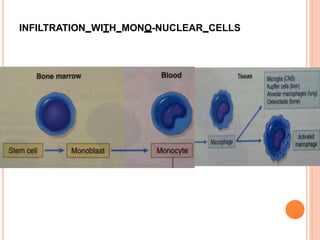 INFILTRATION WITH MONO-NUCLEAR CELLS
 