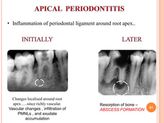 • Inflammation of periodontal ligament around root apex..
Changes localised around root
apex…..since richly vascular.
Vascular changes , infiltration of
PMNLs , and exudate
accumulation
Resorption of bone –
ABSCESS FORMATION
61
 