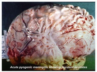 Acute pyogenic meningitis showing purulent exudates
 