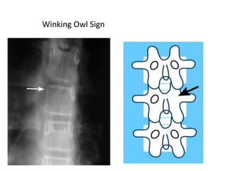 pathological fractures are the one of the important topics asked in ...