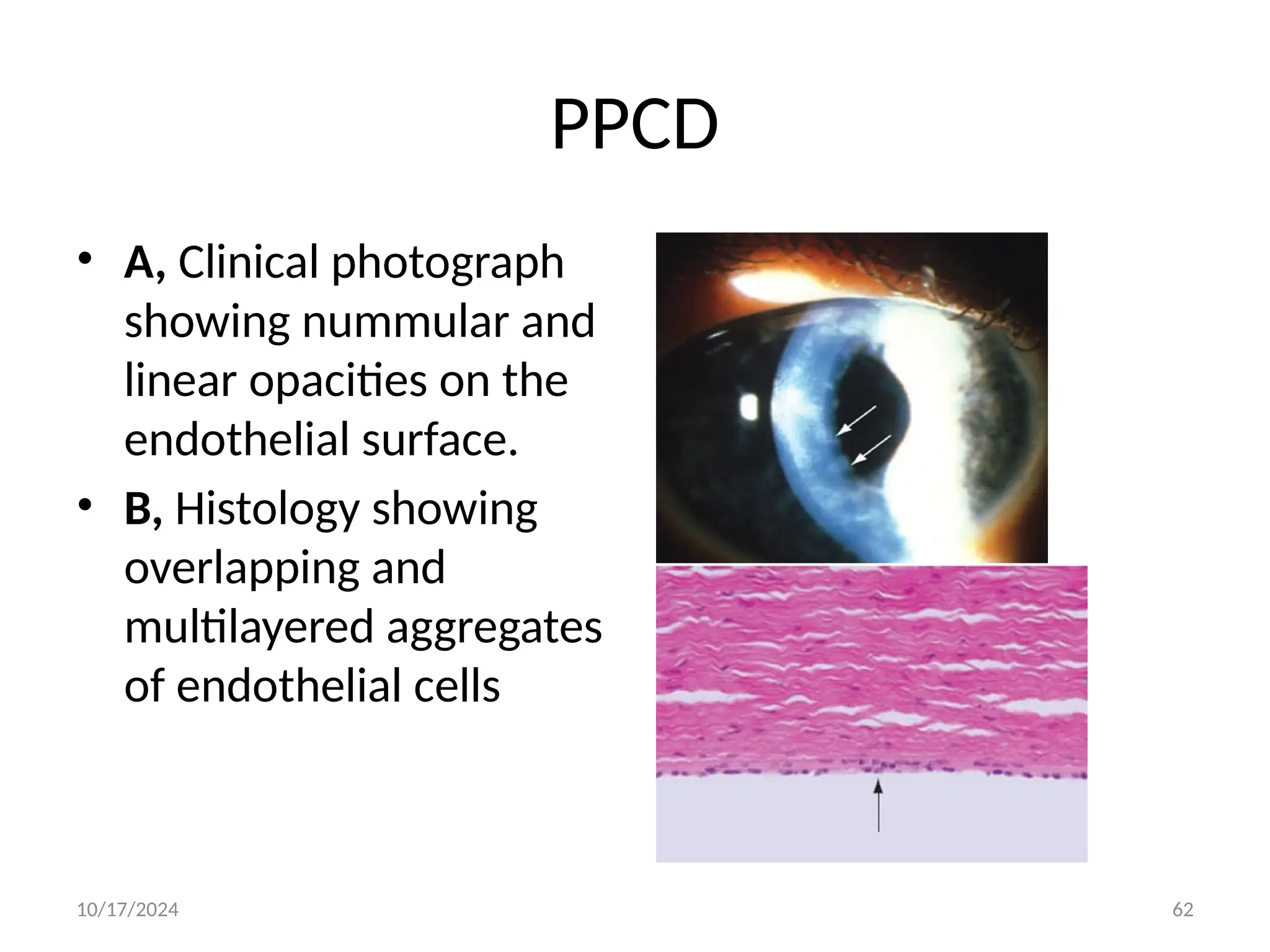 Pathological changes of the cornea,.pptx, congenital cornea defects PPT