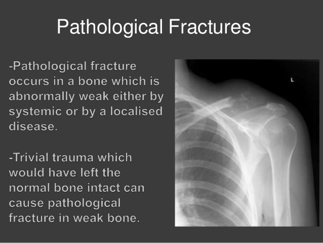 Pathologica L Fractures And Sprain