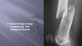 Fracture through a large
metaphyseal Non
Ossifying Fibroma
 