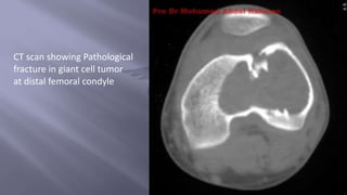 CT scan showing Pathological
fracture in giant cell tumor
at distal femoral condyle
 