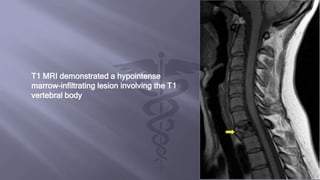 T1 MRI demonstrated a hypointense
marrow-infiltrating lesion involving the T1
vertebral body
 