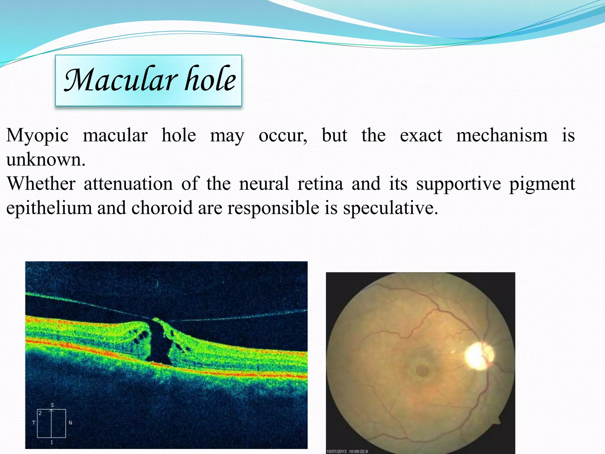 Pathological Myopia.pptx