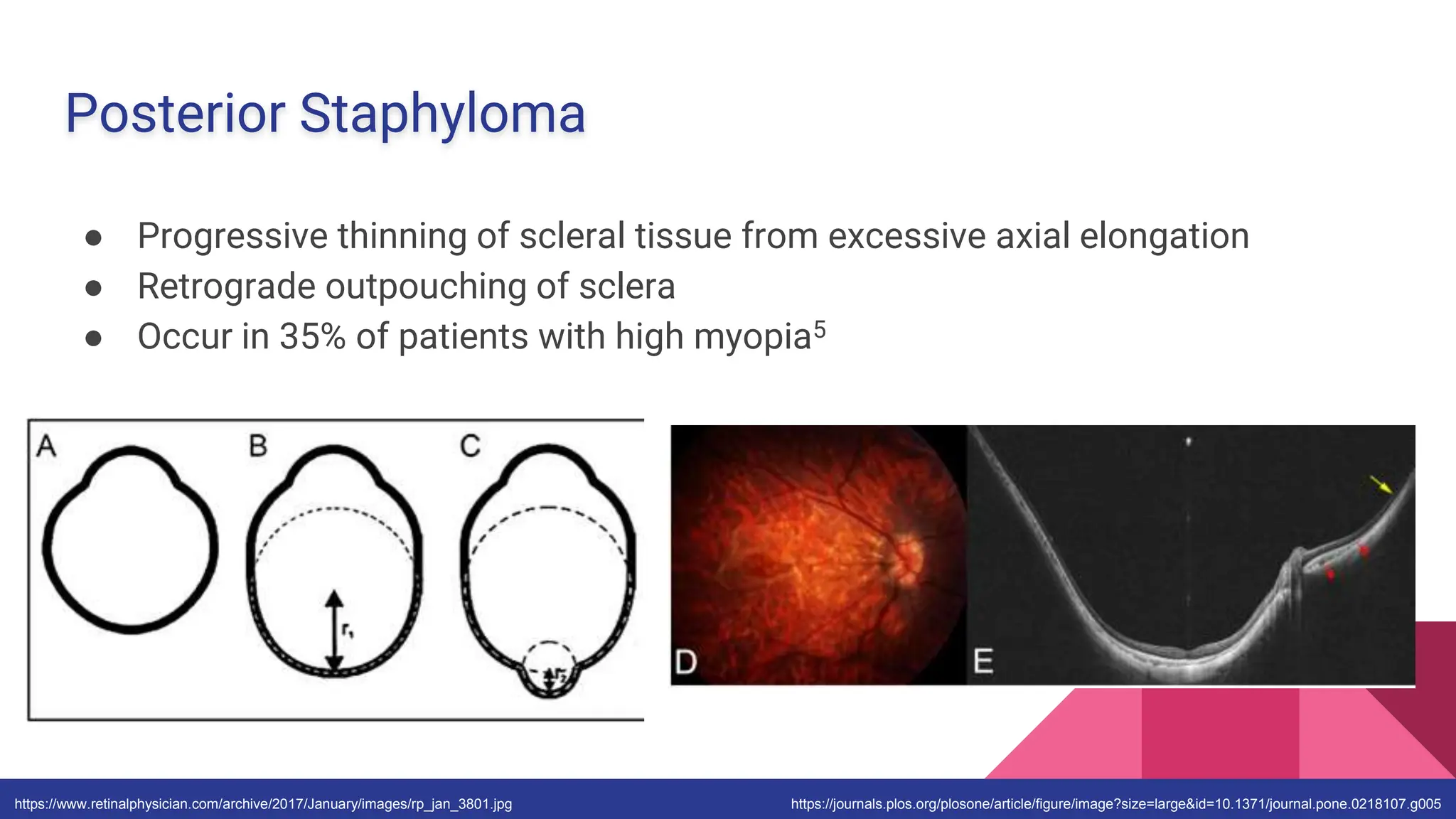 Pathological Myopia and how it can effect CL Rx | PPT