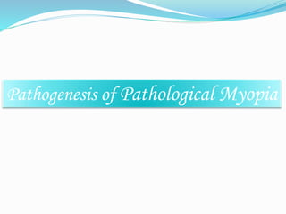 Pathogenesis of Pathological Myopia 
 