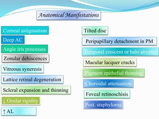 Anatomical Manifestations 
Corneal astigmatism 
Deep AC 
Angle iris processes 
Zonular dehiscences 
Vitreous syneresis 
Lattice retinal degeneration 
Scleral expansion and thinning 
↓ Ocular rigidity 
↑ AL 
Tilted disc 
Peripapillary detachment in PM 
Temporal crescent or halo atrophy 
Macular lacquer cracks 
Pigment epithelial thinning 
Choroidal attenuation 
Foveal retinoschisis 
Post. staphyloma 
 