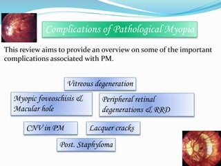 Complications of Pathological Myopia 
This review aims to provide an overview on some of the important 
complications associated with PM. 
Vitreous degeneration 
Peripheral retinal 
degenerations & RRD 
Myopic foveoschisis & 
Macular hole 
CNV in PM Lacquer cracks 
Post. Staphyloma 
 