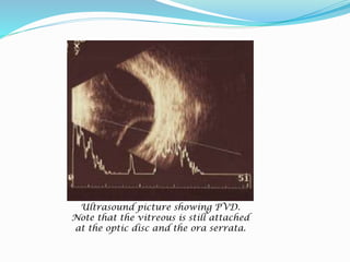 Ultrasound picture showing PVD. 
Note that the vitreous is still attached 
at the optic disc and the ora serrata. 
 