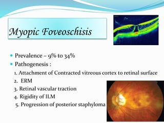 Myopic Foveoschisis 
 Prevalence – 9% to 34% 
 Pathogenesis : 
1. Attachment of Contracted vitreous cortex to retinal surface 
2. ERM 
3. Retinal vascular traction 
4. Rigidity of ILM 
5. Progression of posterior staphyloma 
 