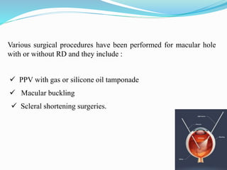 Various surgical procedures have been performed for macular hole 
with or without RD and they include : 
 PPV with gas or silicone oil tamponade 
 Macular buckling 
 Scleral shortening surgeries. 
 