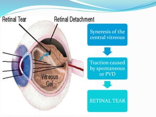 Syneresis of the 
central vitreous 
Traction caused 
by spontaneous 
or PVD 
RETINAL TEAR 
 