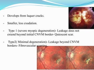 - Develops from laquer cracks. 
- Smaller, less exudation. 
- Type 1 (severe myopic degeneration)- Leakage does not 
extend beyond initial CNVM border- Quiescent scar. 
- Type2( Minimal degeneration)- Leakage beyond CNVM 
borders- Fibrovascular scarring. 
 