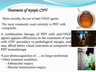 Treatment of myopic CNV 
More recently, the use of anti-VEGF agents 
The most commonly used currently is PDT with 
verteporfin. 
A combination therapy of PDT with anti-VEGF 
agents appears efficacious in the treatment of eyes 
with CNV secondary to pathological myopia, and 
may afford better visual outcomes as compared to 
PDT monotherapy 
•Laser photocoagulation of …. no longer performed. 
• Other treatment modalities 
- Submacular surgery 
- Macular translocation surgery 
 