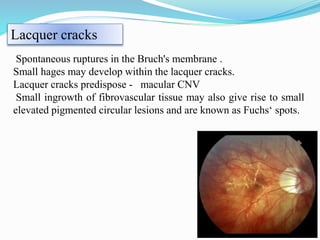 Lacquer cracks 
Spontaneous ruptures in the Bruch's membrane . 
Small hages may develop within the lacquer cracks. 
Lacquer cracks predispose - macular CNV 
Small ingrowth of fibrovascular tissue may also give rise to small 
elevated pigmented circular lesions and are known as Fuchs‘ spots. 
 