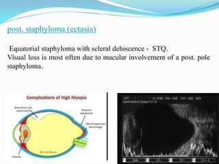 post. staphyloma (ectasia) 
Equatorial staphyloma with scleral dehiscence - STQ. 
Visual loss is most often due to macular involvement of a post. pole 
staphyloma. 
 