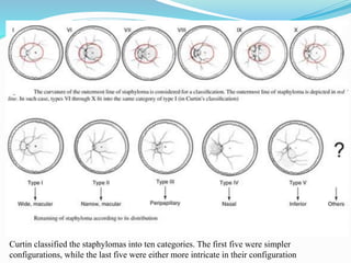 Curtin classified the staphylomas into ten categories. The first five were simpler 
configurations, while the last five were either more intricate in their configuration 
 