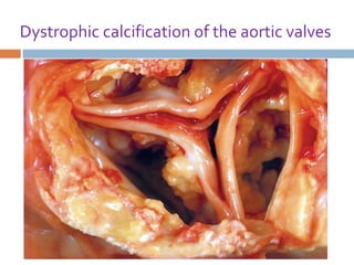 Dystrophic calcification of the aortic valves

 