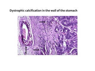 Dystrophic calcification in the wall of the stomach

 