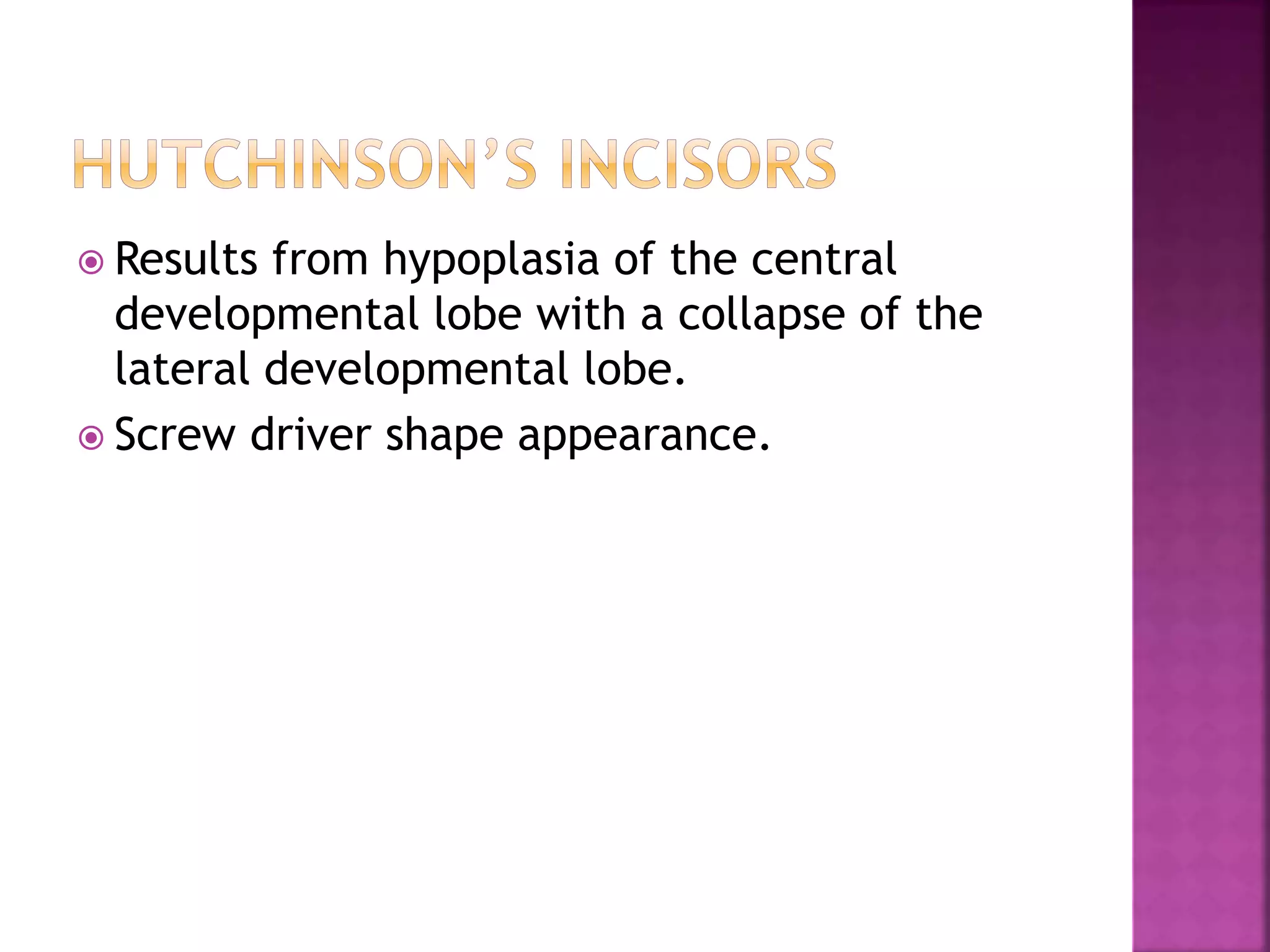  Results from hypoplasia of the central 
developmental lobe with a collapse of the 
lateral developmental lobe. 
 Screw driver shape appearance. 
 