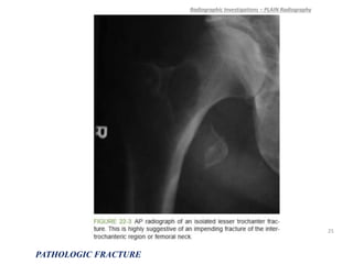 Radiographic Investigations – PLAIN Radiography
PATHOLOGIC FRACTURE
25
 
