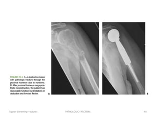 Upper-Extremity Fractures PATHOLOGIC FRACTURE 40
 