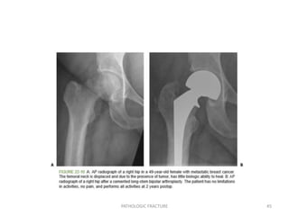 PATHOLOGIC FRACTURE 45
 