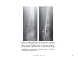 PATHOLOGIC FRACTURE 47
 