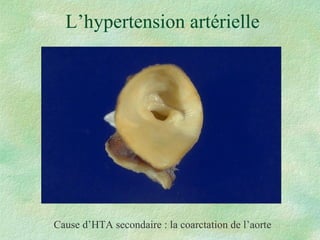 L’hypertension artérielle Cause d’HTA secondaire : la coarctation de l’aorte 