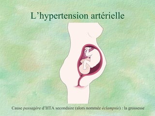 L’hypertension artérielle Cause  passagère  d’HTA secondaire (alors nommée  éclampsie ) : la grossesse 
