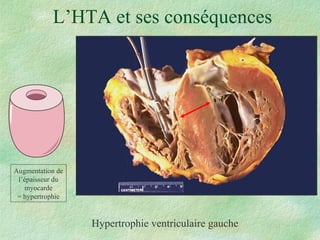 L’HTA et ses conséquences Hypertrophie ventriculaire gauche Augmentation de l’épaisseur du myocarde = hypertrophie 