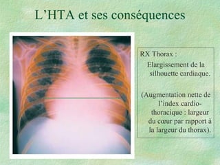 L’HTA et ses conséquences RX Thorax : Elargissement de la silhouette cardiaque. (Augmentation nette de l’index cardio-thoracique : largeur du cœur par rapport à la largeur du thorax). 