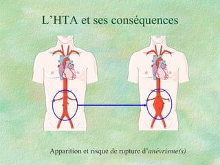 L’HTA et ses conséquences Apparition et risque de rupture d’ anévrisme(s) 