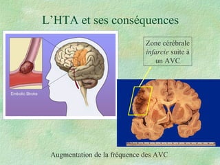 L’HTA et ses conséquences Augmentation de la fréquence des AVC Zone cérébrale infarcie  suite à un AVC 