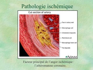 Pathologie ischémique Facteur principal de l’angor ischémique : l’athéromatose coronaire. 