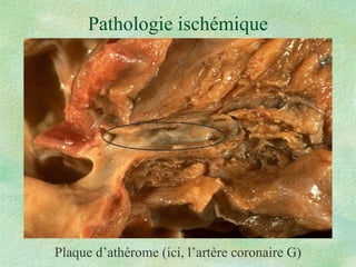 Pathologie ischémique Plaque d’athérome (ici, l’artère coronaire G) 