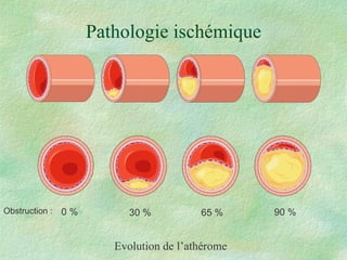 Pathologie ischémique Evolution de l’athérome Obstruction : 0 % 30 % 65 % 90 % 