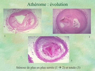 Athérome : évolution Sténose de plus en plus serrée (1    2) et totale (3) 1 2 3 