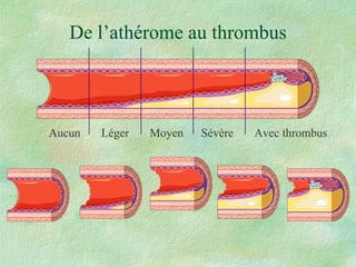 De l’athérome au thrombus Aucun  Léger  Moyen  Sévère  Avec thrombus 