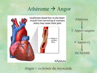Athérome    Angor Angor =  ischémie  du myocarde Athérome    Apport sanguin    Apport O 2 ISCHEMIE 