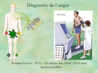 Diagnostic de l’angor Pendant la crise : ECG – En dehors des crises : ECG sous épreuve d’effort L R N F 