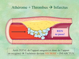 Athérome + Thrombus    Infarctus RIEN ne passe! Arrêt  TOTAL  de l’apport sanguin (et donc de l’apport en oxygène)    l’ischémie devient  NECROSE  = INFARCTUS 