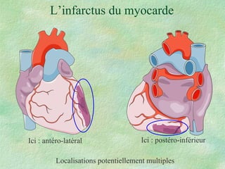 L’infarctus du myocarde Localisations potentiellement multiples Ici : antéro-latéral Ici : postéro-inférieur 