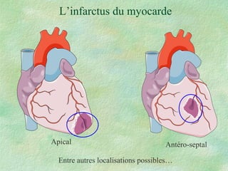L’infarctus du myocarde Entre autres localisations possibles… Antéro-septal Apical 